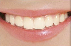 Invisalign Invisible Braces 
