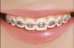 Metal Braces 