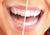 Whitening teeth Scarborough ME