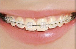 Clear Ceramic Braces